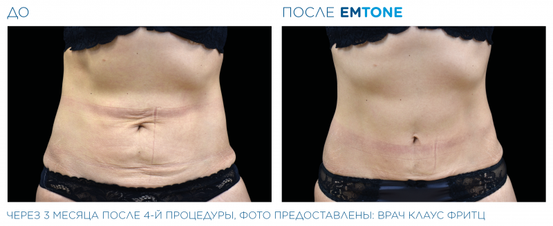 emtone_pic_ba-card-female-abdomen-023_ru100.png-800x327.png