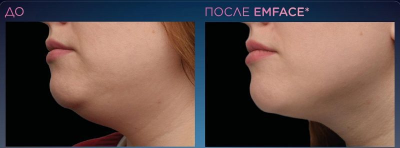 emface_ppt_submentum-product-presentat8-800x297.jpg