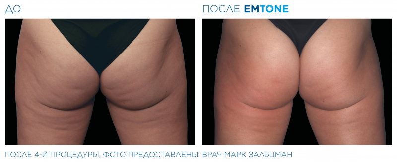 emtone_pic_ba-card-female-buttock-001_ru100.png-800x327.png