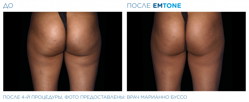 emtone_pic_ba-card-female-buttock-006_ru100.png-800x327.png